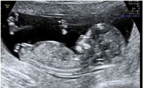 Sex of baby