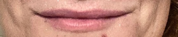 I don't like my lip fillers, my top lip turns up! :(