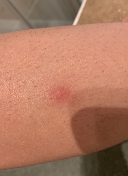 Should a bite hurt this much 3 days later?!
