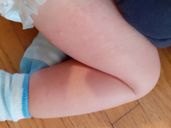 Worried about toddler rash