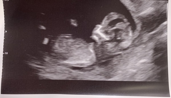 Gender guesses? We find out today 😆💙💗