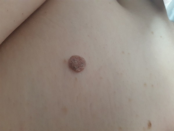 Is this a mole or a skin tag? (Photo attached).