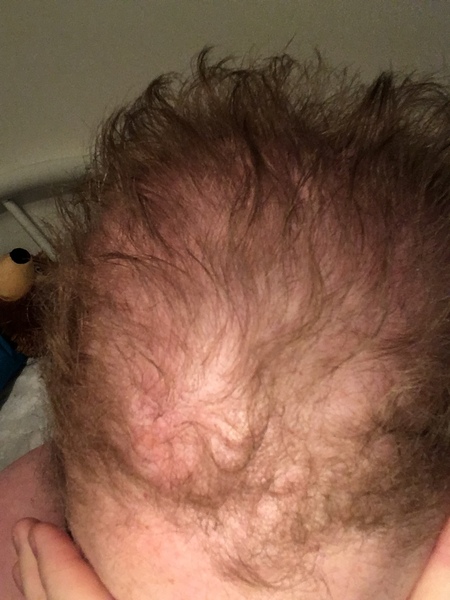 Androgenic Alopecia 😔