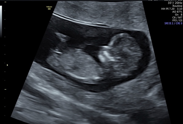 Pregnant After MMC - Thread 3