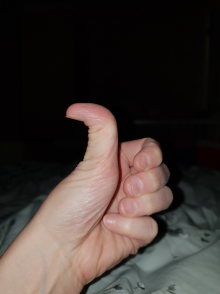 Is my thumb weird?