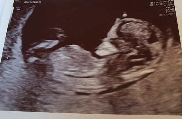 Pregnant After MMC - Thread 3