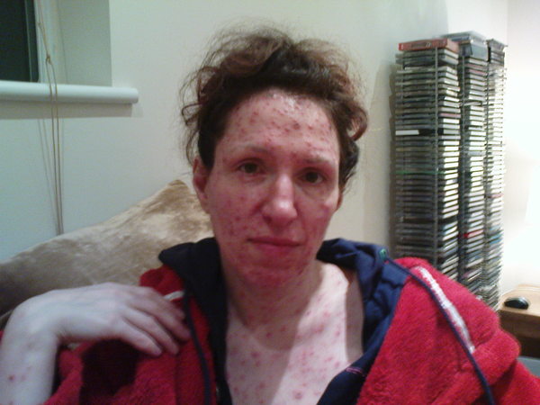 To pox or not to pox...