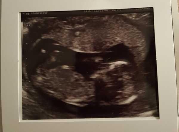Is my baby a boy or girl??