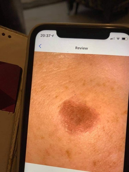 Anyone have any experience of skin cancer?