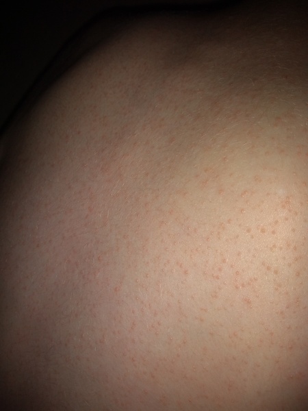 Is this an allergic reaction or something else? Dd4.