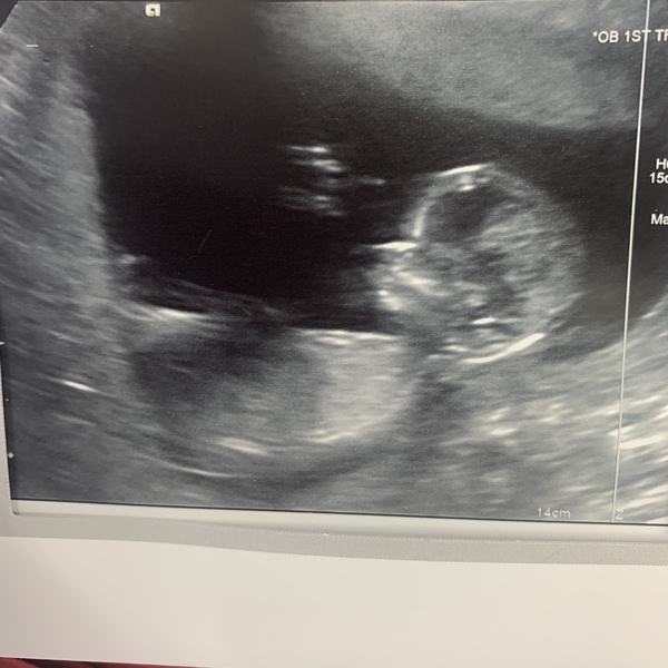 Pregnant After MMC - Thread 2