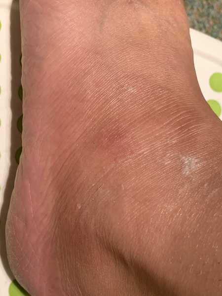 Should a bite hurt this much 3 days later?!
