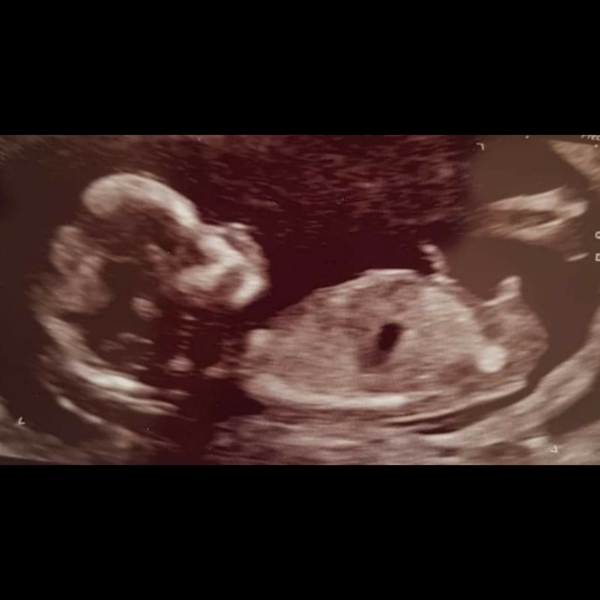 Nub guesses before my 5 month scan
