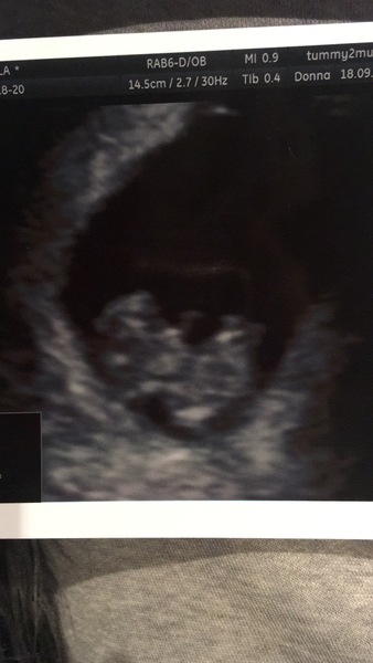 Pregnant After MMC - Thread 2