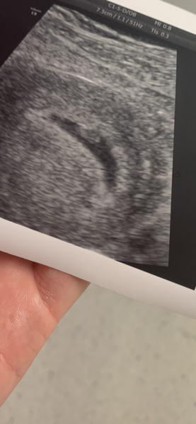 Does my gestational sac look ok?