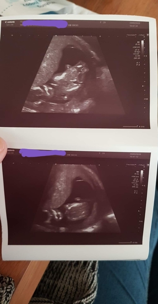 Pregnant After MMC - Thread 3