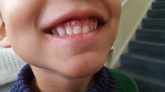 Is this a coldsore?