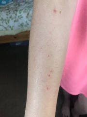 What is this rash on dd’s arm?