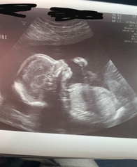 20 Week Scan (Boy or Girl)