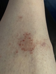 What on EARTH are these patches all over my body..?
