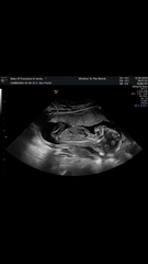 Nasal bone 17 wk scan