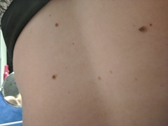 Can anyone make me feel better? Found two dodgy looking moles :( anyone had similar?