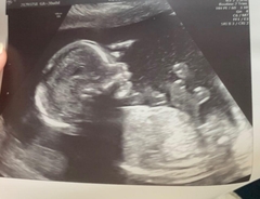 20 Week Scan (Boy or Girl)