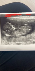 12+2 scan..anyone want to guess the sex?