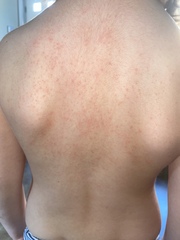 Is this an allergic reaction or something else? Dd4.