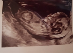 Nasal bone on scan
