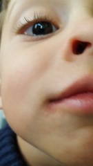 Is this a coldsore?