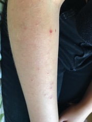 What is this rash on dd’s arm?