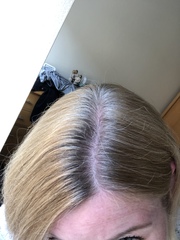 Androgenic Alopecia 😔