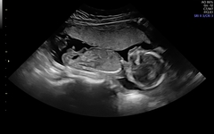 Nasal bone on scan