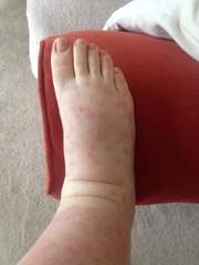 Mystery illness - hives and burning legs - pics