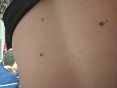 Can anyone make me feel better? Found two dodgy looking moles :( anyone had similar?