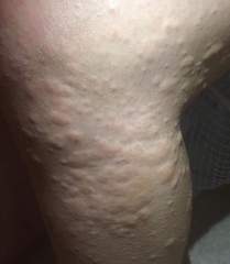 Mystery illness - hives and burning legs - pics
