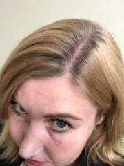 Androgenic Alopecia 😔