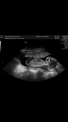 Nasal bone 17 wk scan