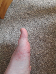 Help. What is this. rash on foot.