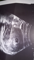 Ramzi theory anyone? 7 weeks scan