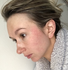 Help with skincare regime? Pics attached.