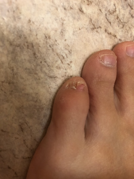 Growth over toe nail