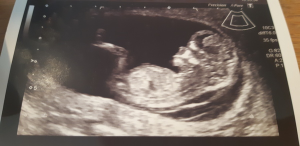 Boy or Girl? (13 week scan)