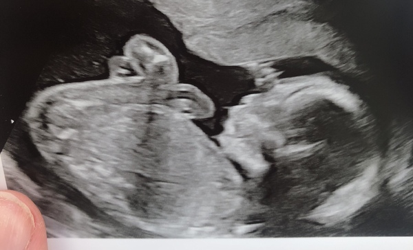 Boy or girl? Desperate to know now! :)