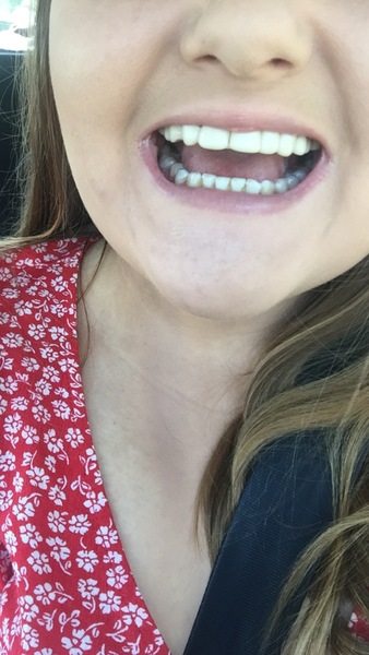 Clip on veneers
