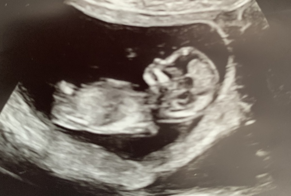 Boy or Girl?