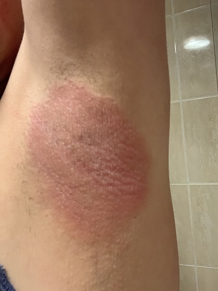 AIBU to ask what this rash is?