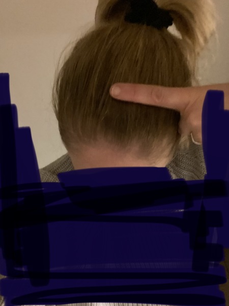 Has anyone got a lump where I have? On their head? **pic**