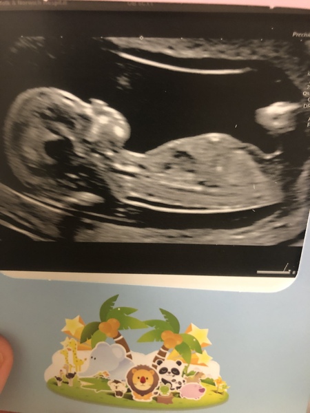 Boy or girl? Sonographer had a guess